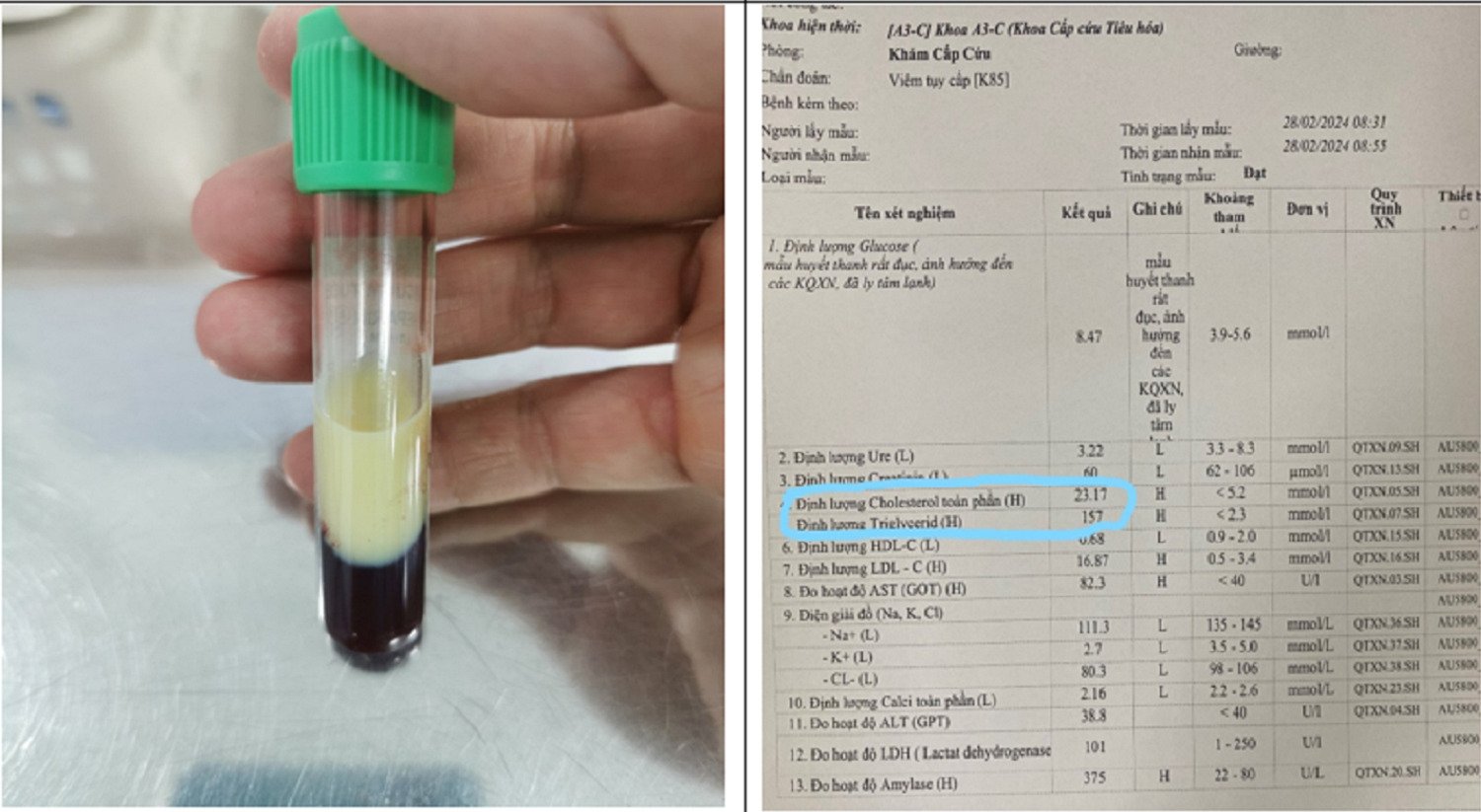 Cứu sống bệnh nhân biến chứng viêm tụy cấp do tăng mỡ máu